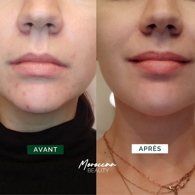 Nour Routine - Clear Skin